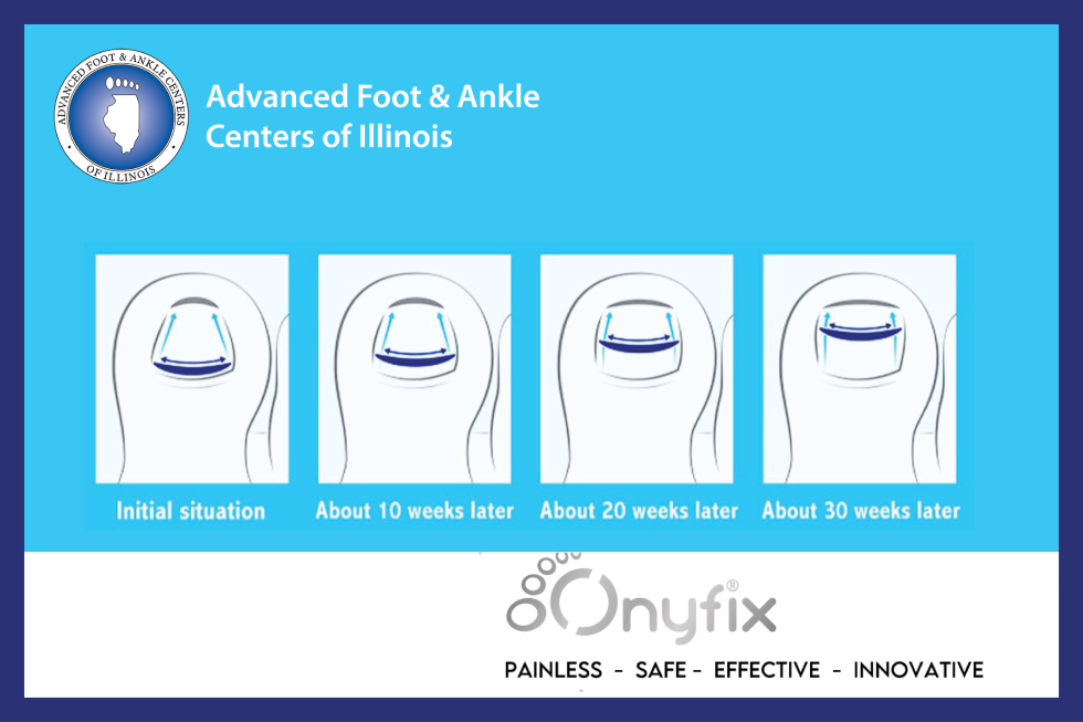 What Is Onyfix? Pain-free Nail Correction - Kenosha.com